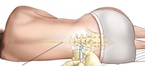 Beneficios de la Anestesia Regional, Versus Anestesia General en pacientes embarazadas.